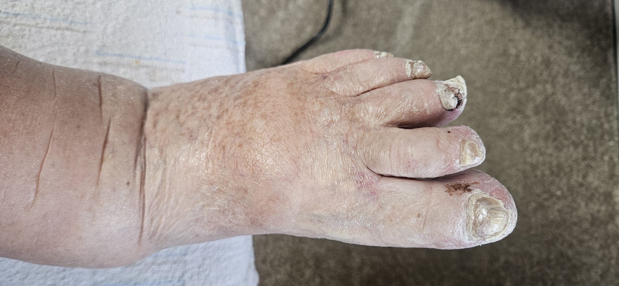 Fachgerechte Fußpflege bei ausgeprägten altersbedingten Nagelveränderungen