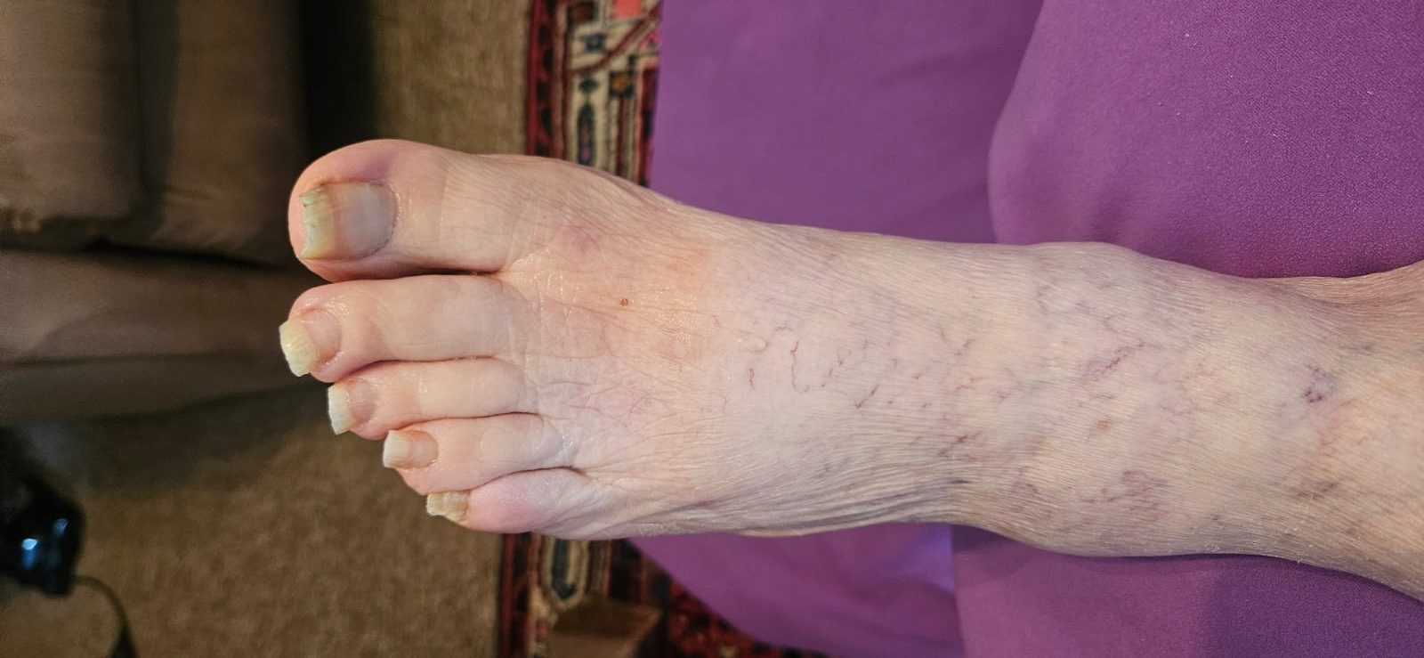 Fußpflege bei stark verdickten und verhärteten Fußnägeln