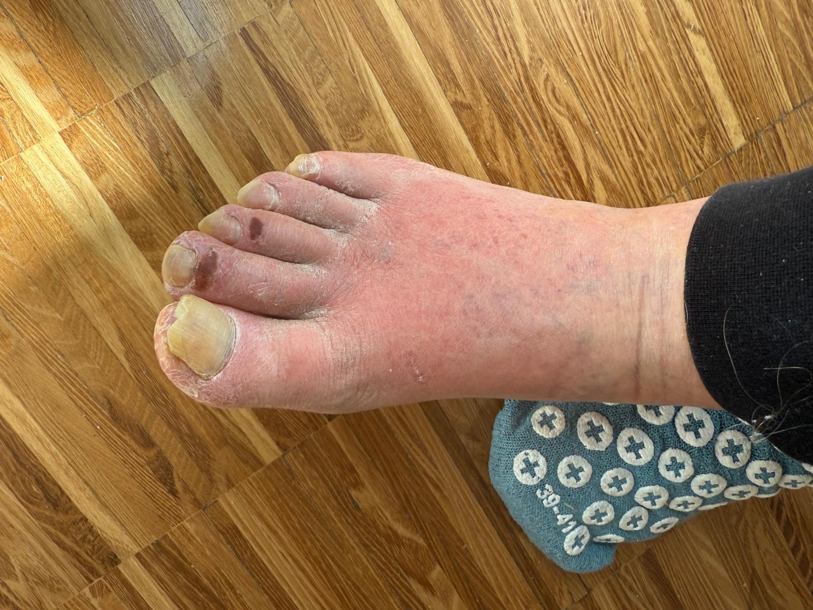 Medizinische Fußpflege bei stark ausgeprägten altersbedingten Beschwerden