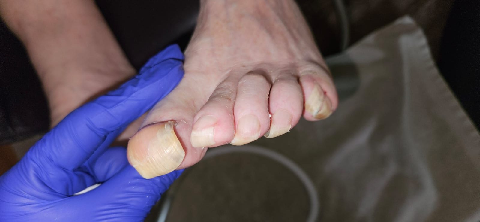 Behandlung krallenförmig gewachsener Fußnägel (Onychogrypose)