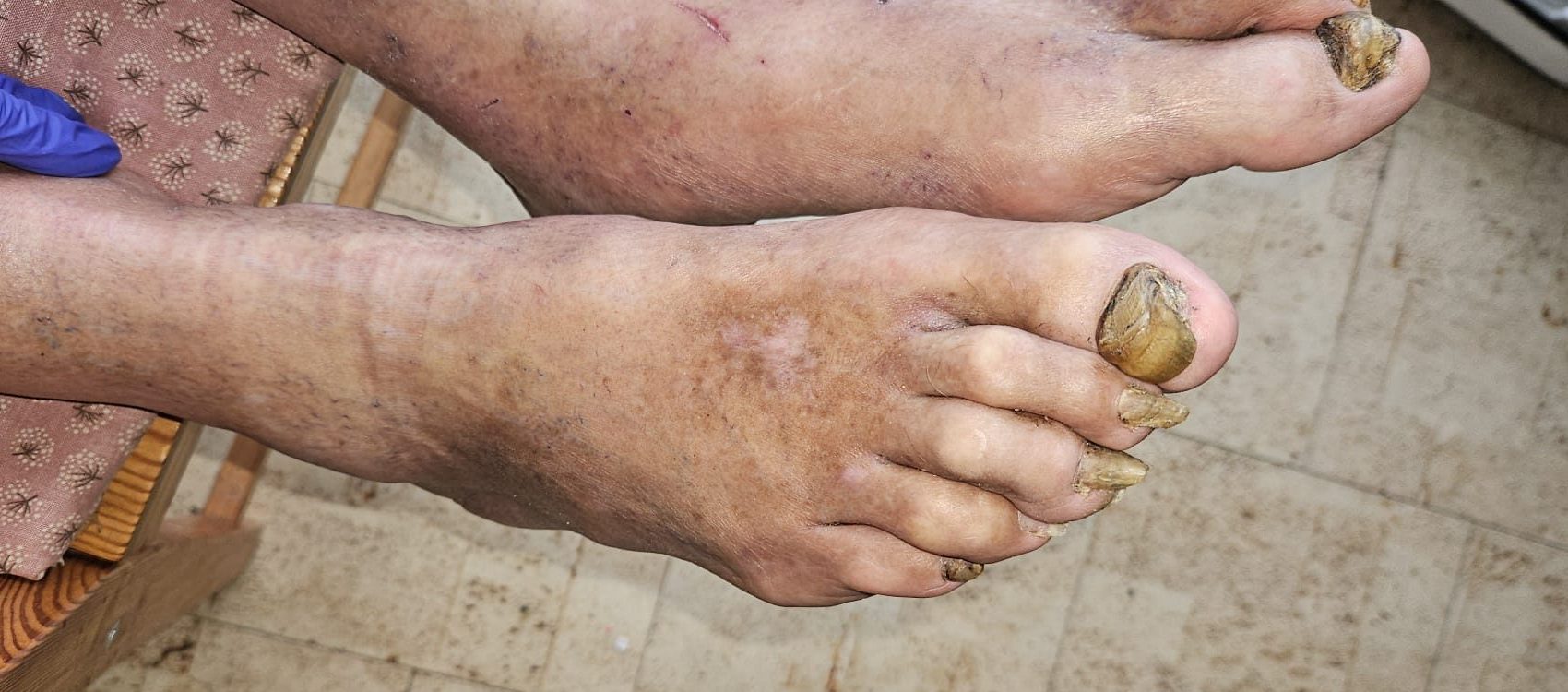 Medizinische Fußpflege bei stark verformten und verdickten Fußnägeln