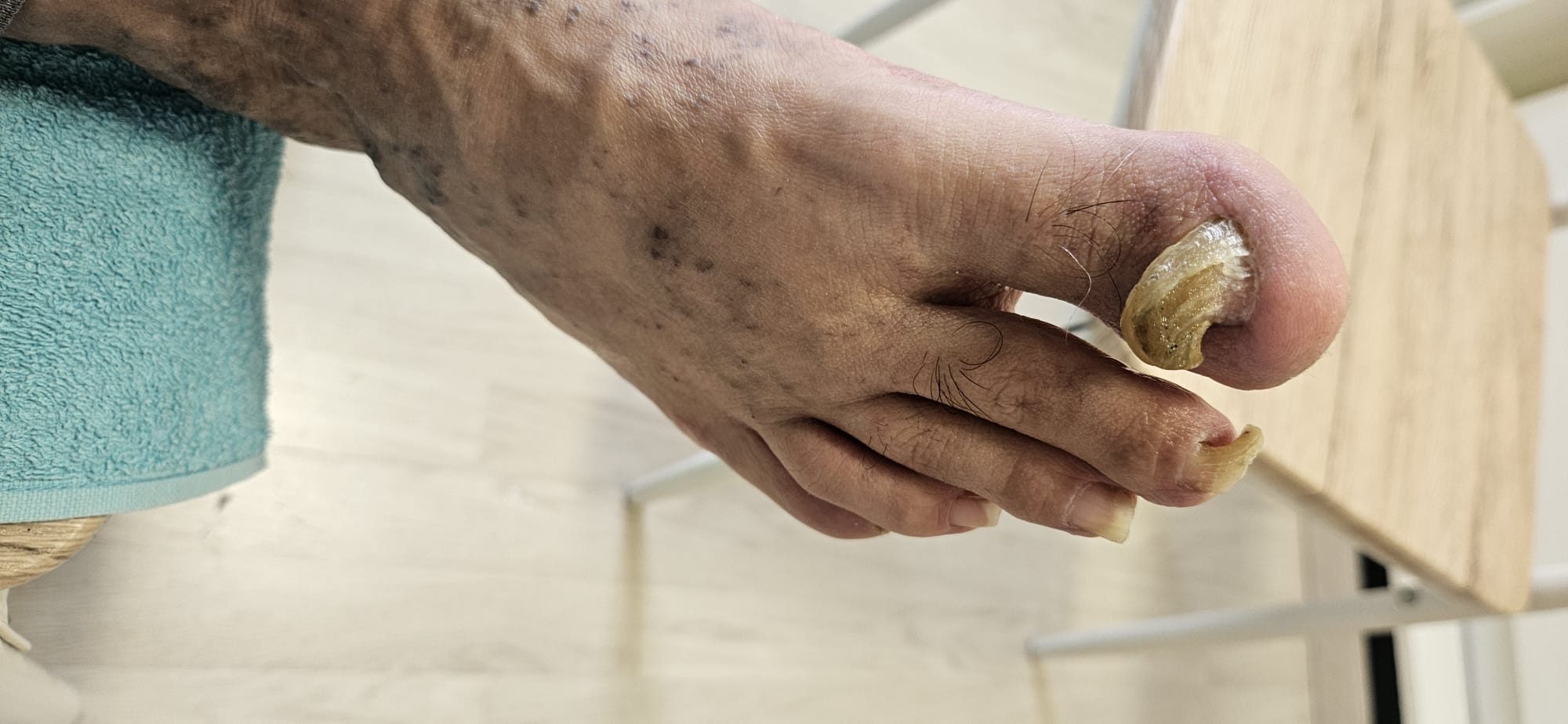 Versorgung stark verformter und krallenförmig gewachsener Fußnägel