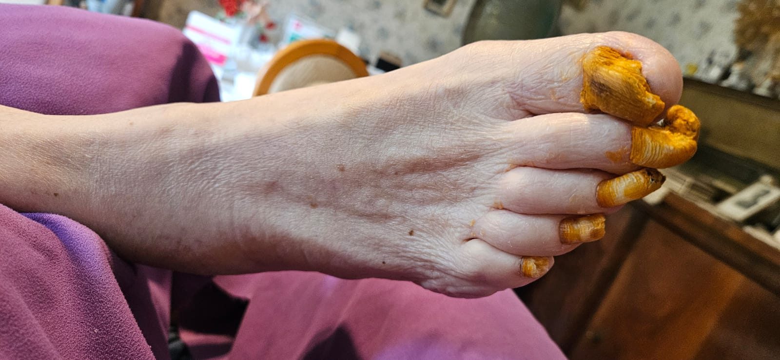 Versorgung komplexer Fußzustände im häuslichen Umfeld