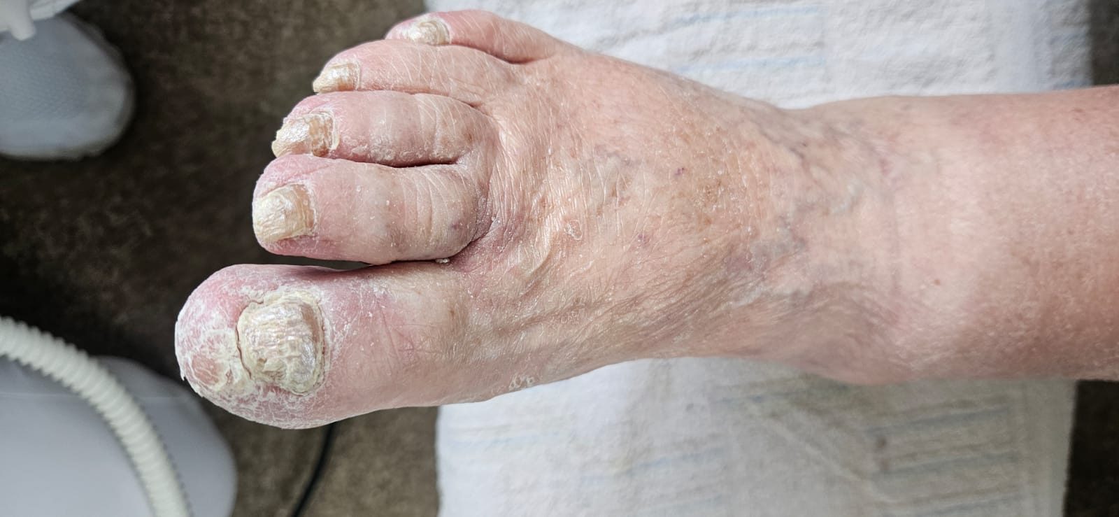 Behandlung stark verdickter Nägel und belasteter Hautbereiche