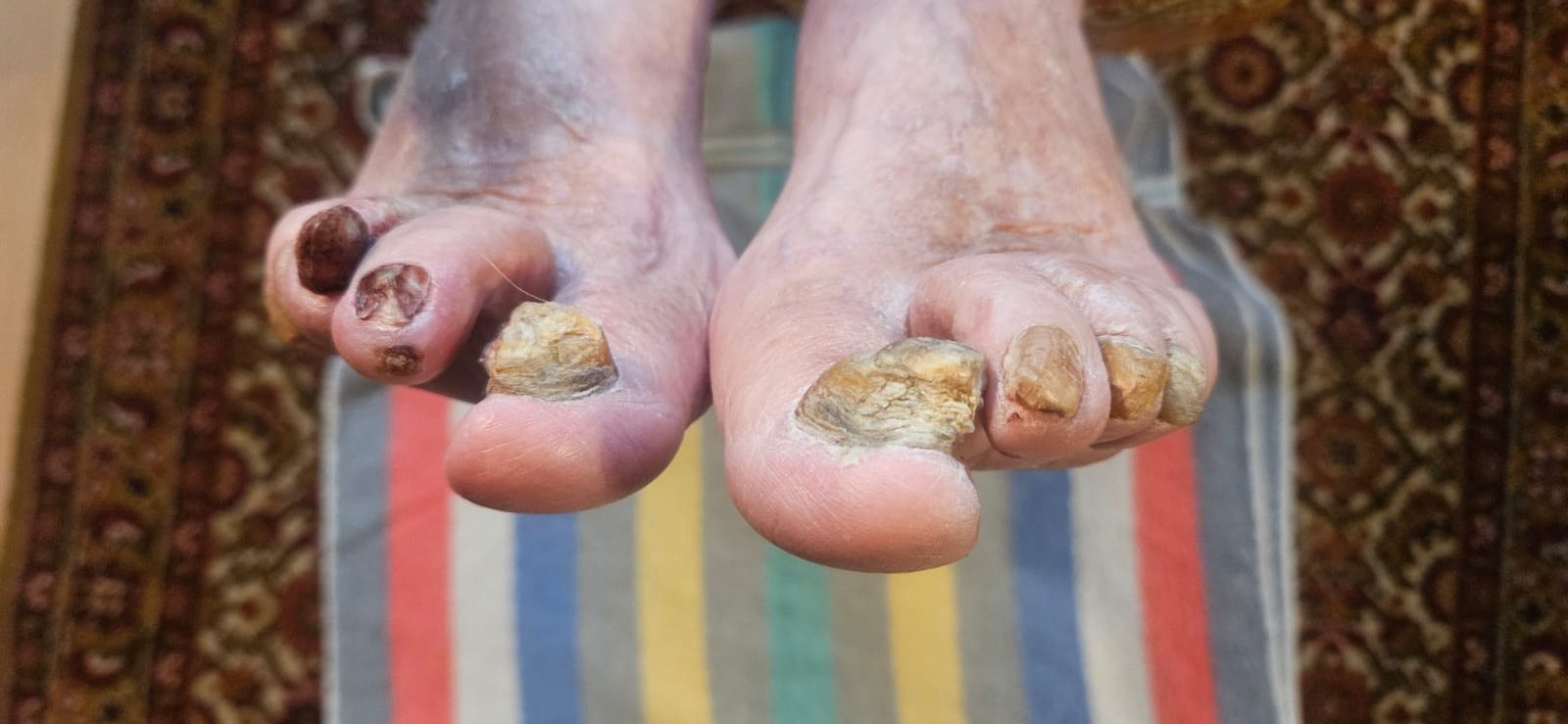 Versorgung sehr anspruchsvoller Fußzustände im häuslichen Umfeld