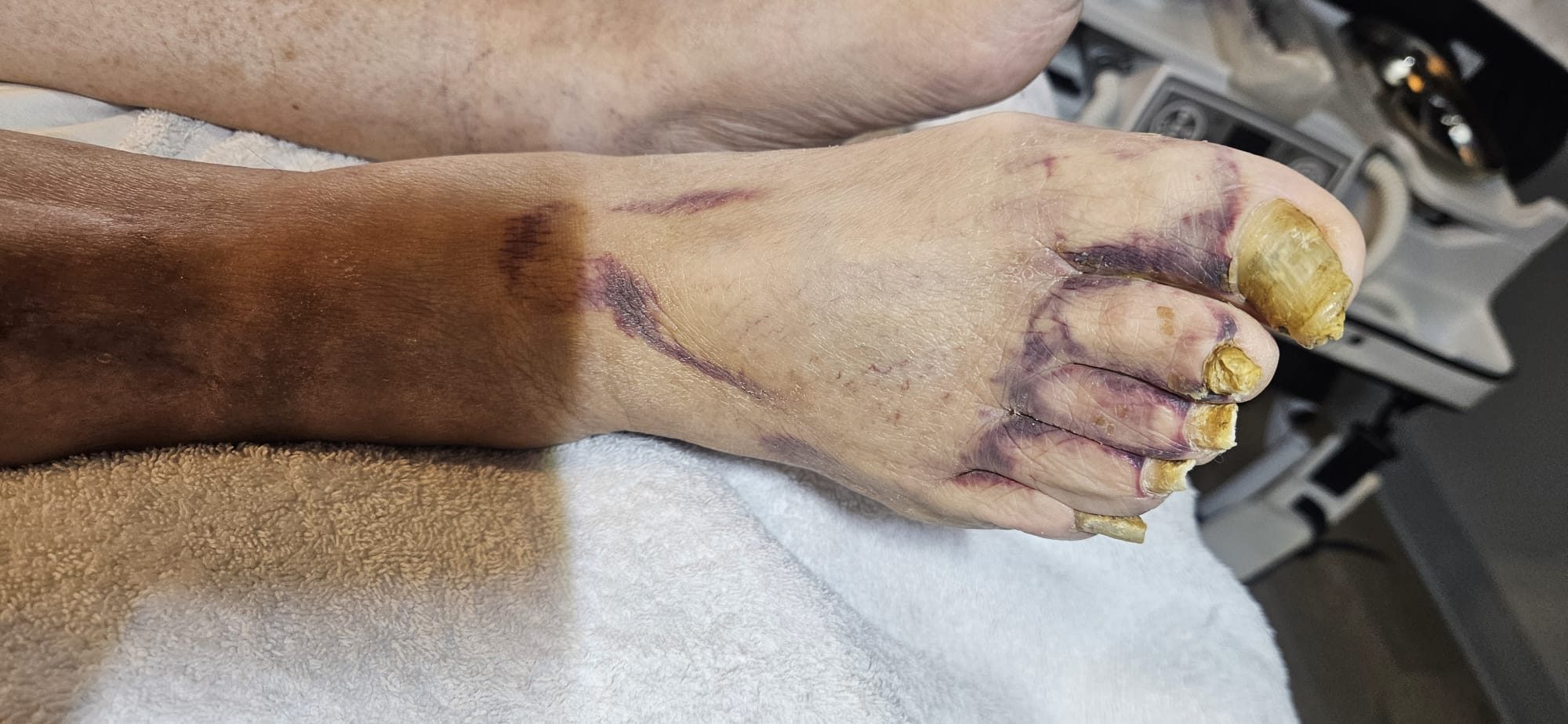 Medizinische Fußpflege bei stark verdickten Fußnägeln (Holznägeln)