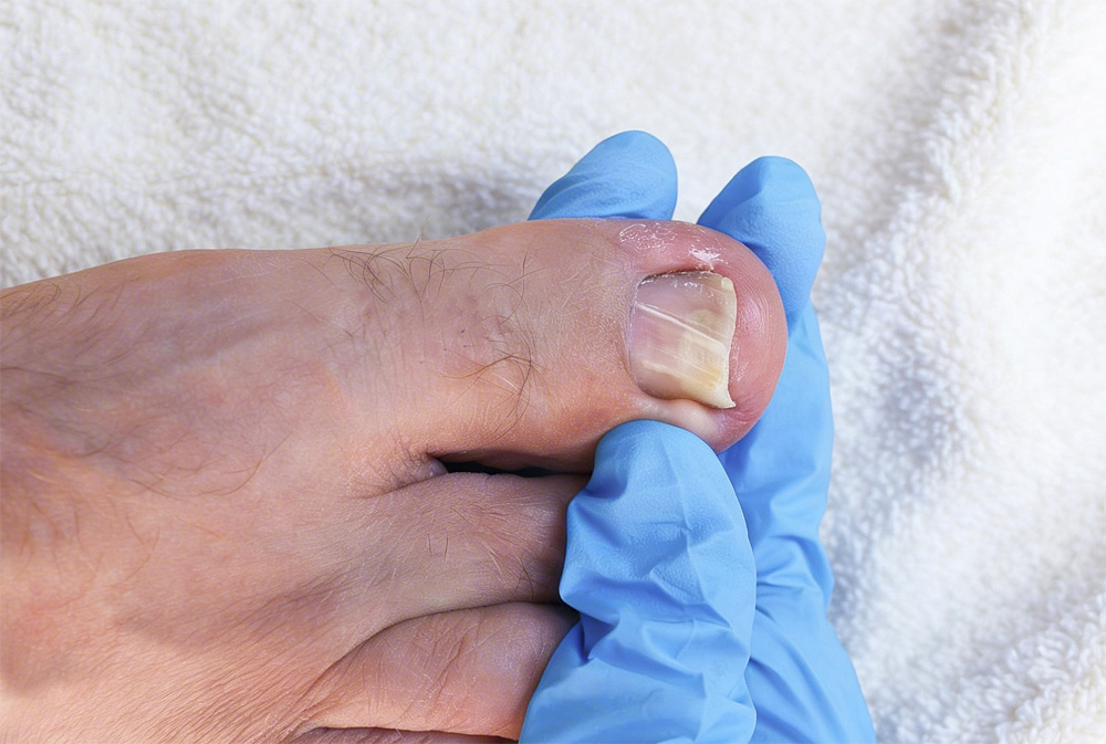 Eingewachsener Zehennagel (Onychocryptosis)
