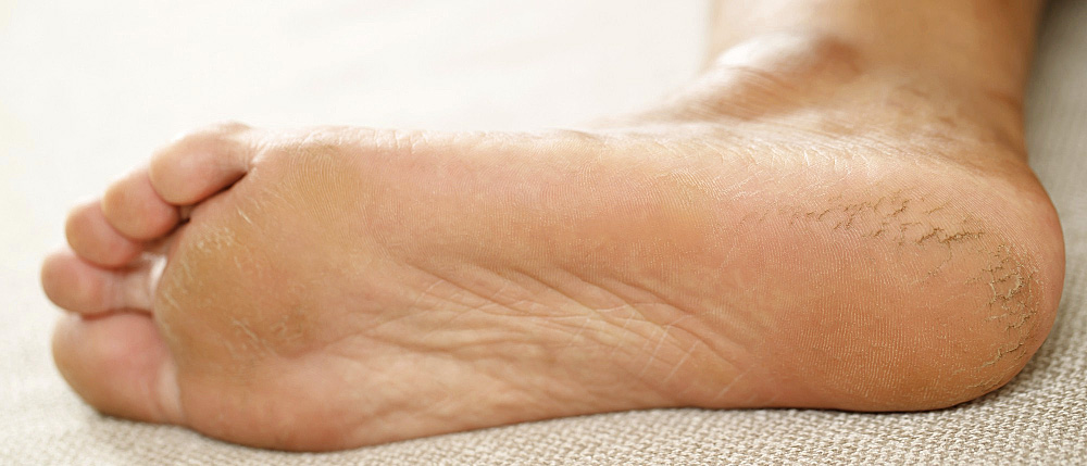 Starke Hornhautbildung (Hyperkeratose)