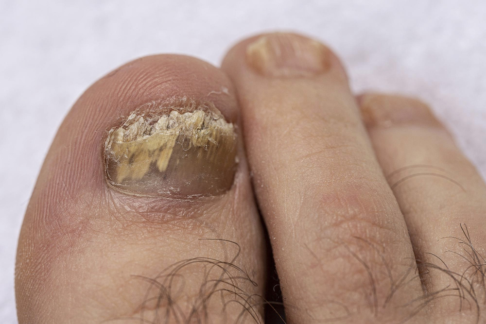 Pilzbefallener Zehennagel (Onychomykose)