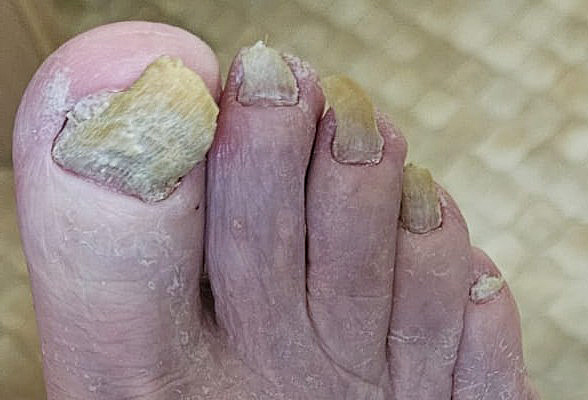 Verdickte Fußnägel (Onychauxis)